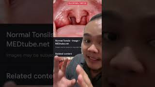 BENGKAK TONSIL SEMBUH DENGAN AISKRIM VANILA?