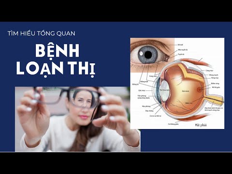 Những Điều Bạn Chưa Biết Về Bệnh Loạn Thị