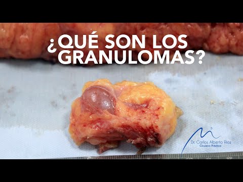 Vídeo: Granuloma De Mama: Causas, Diagnóstico Y Tratamiento De Los Granulomas De La Glándula Mamaria Y Del Ombligo