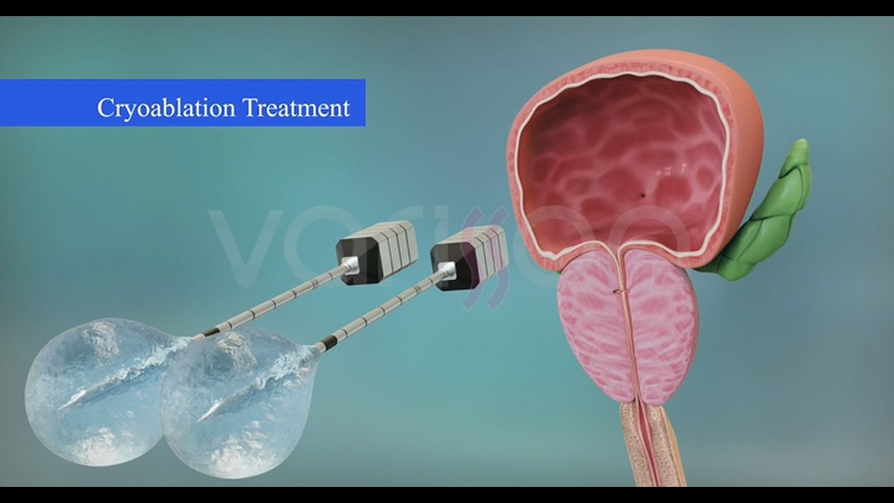 КРИОАБЛЯЦИОННОЕ ЛЕЧЕНИЕ ДОБРОКАЧЕСТВЕННОЙ ГИПЕРПЛАЗИИ ПРОСТАТЫ (ДГПЖ ...