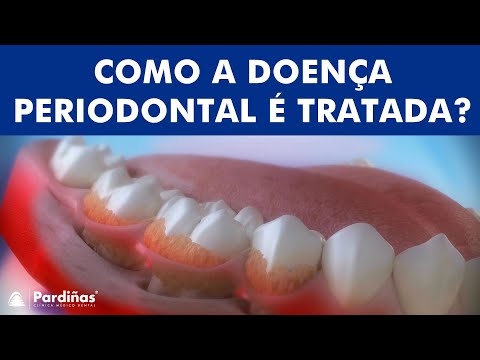 Vídeo: Como tratar a doença periodontal: 14 etapas (com fotos)