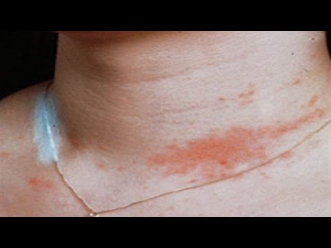 حساسية النيكلNickel allergy |نصائح للتعامل مع حساسية الجلد بسبب مادة الـ Nickel النكيل في الاكسسوار