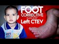 Foot Corrective Surgery Left l CTEV | Dr Ashfaq Jadoon  @mahabanhospital