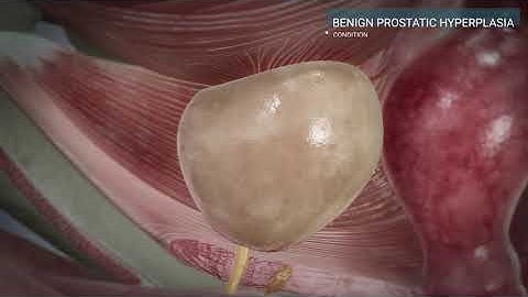 Urology. BPH - Benign prostatic hyperplasia
