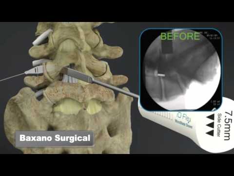 Sciatica Surgery, Dr.