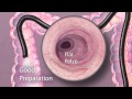 The importance of good bowel preparation during colonoscopy