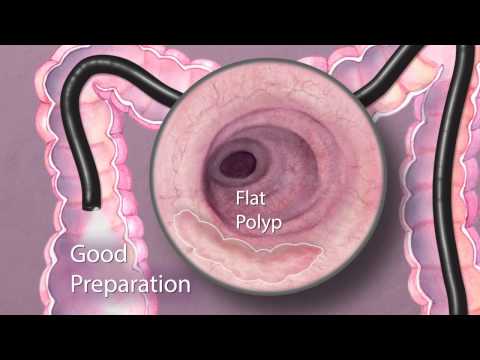 The Importance of Good Bowel Preparation During Colonoscopy