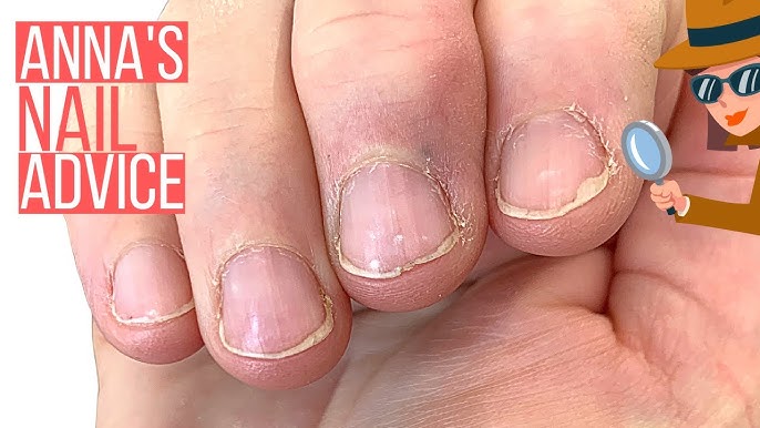 Gentle Shellac Removal and Manicure [How nail shape can change after polish  wear] 