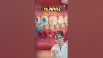 Niềng răng như thế nào