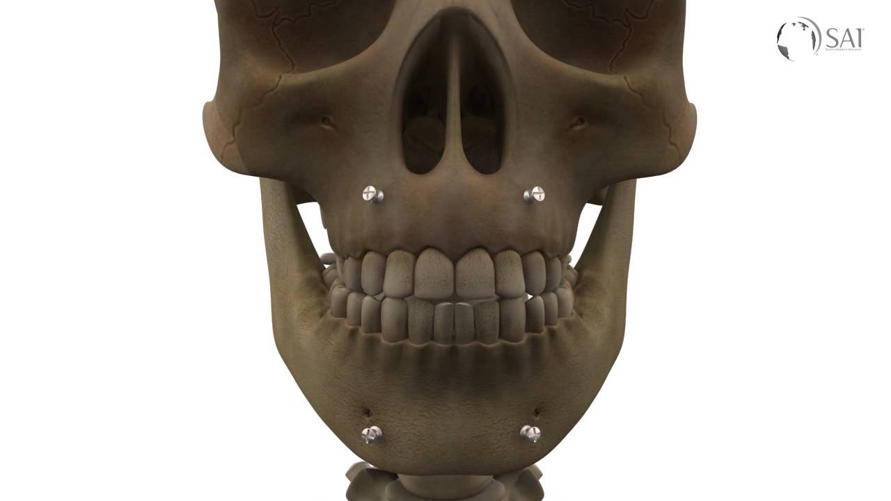 South America Implants S.A. - DC-526-00 Sistema eFix