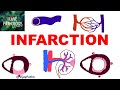 INFARCTION: Causes, Types, Morphology