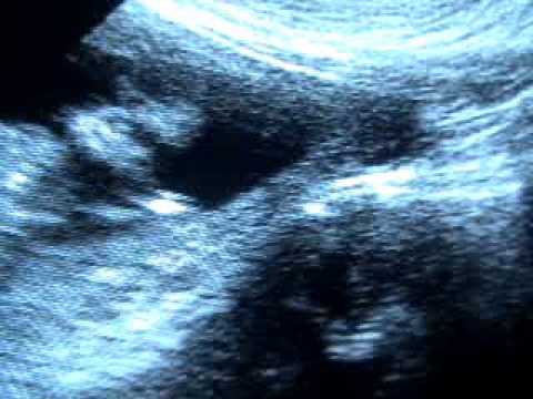 Ecografía de Feto de 13 semanas de gestación- Baby Ultrasound at 13 weeks in Nulliparous patient.S/he is pretty active!