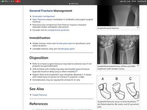 אורתופדיה - שבר בסקפואיד - scaphoid fracture