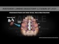 Posterior Lumbar Discectomy & Fusion of L4-S1