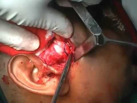 Temperomandibular Joint Ankylosis Surgery.......