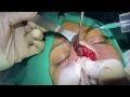 Rhinoplastydrillinstrumentalrhinoplastyturkey