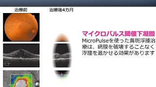 ピュアイエロー・レーザー光凝固装置 IQ577