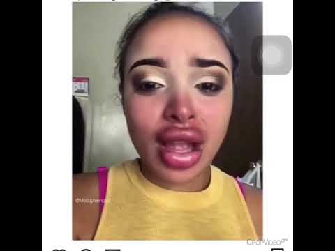 Girl cries because Lip fillers went wrong!!!