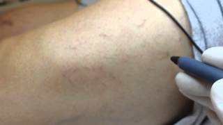 Kilcal Vari̇slerde Termokoagülasyon Tedavi̇si̇