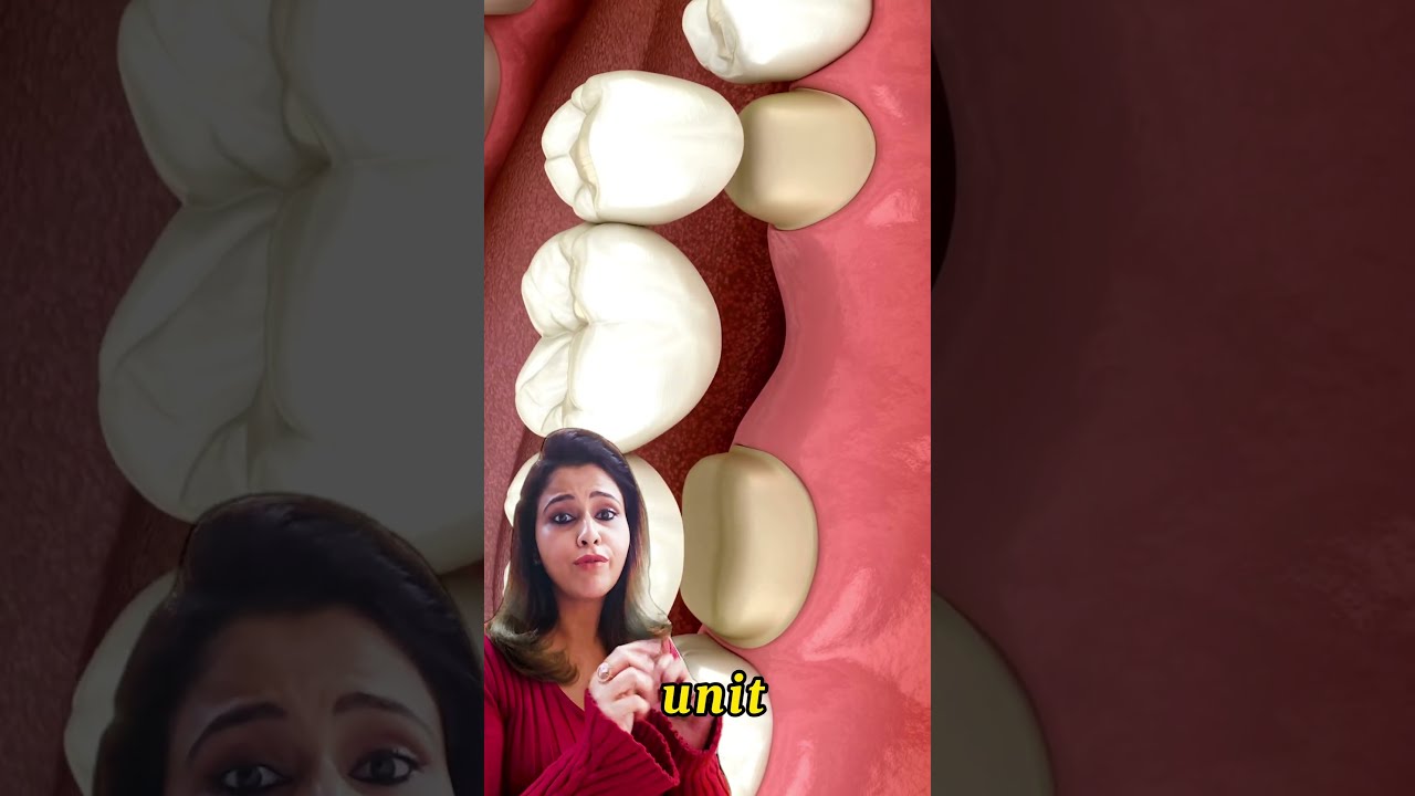 Unlocking The Mystery Dental Implant Vs Bridge Cosmodent India Implants