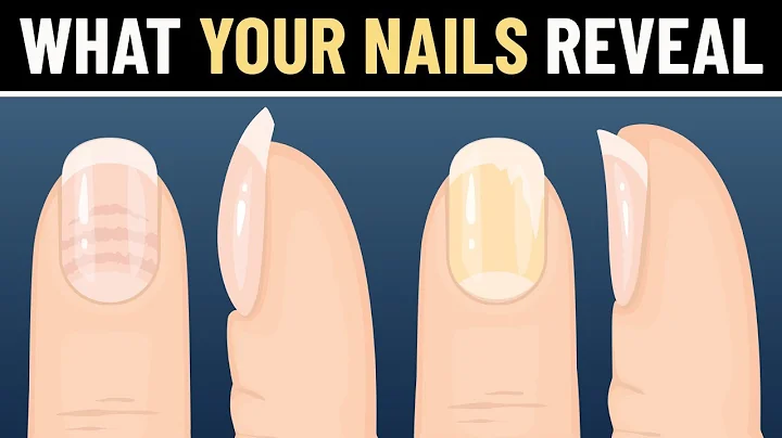 10 Things Your Nails Reveal About Your Health