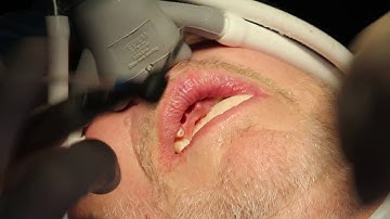 Vincent Vella DDS Osseodensification Procedure