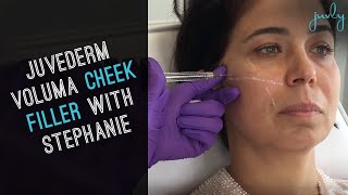 Juvederm Voluma Cheek Filler to look young | Juvly Aesthetics