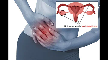 ¿Dónde se localiza el dolor de útero?