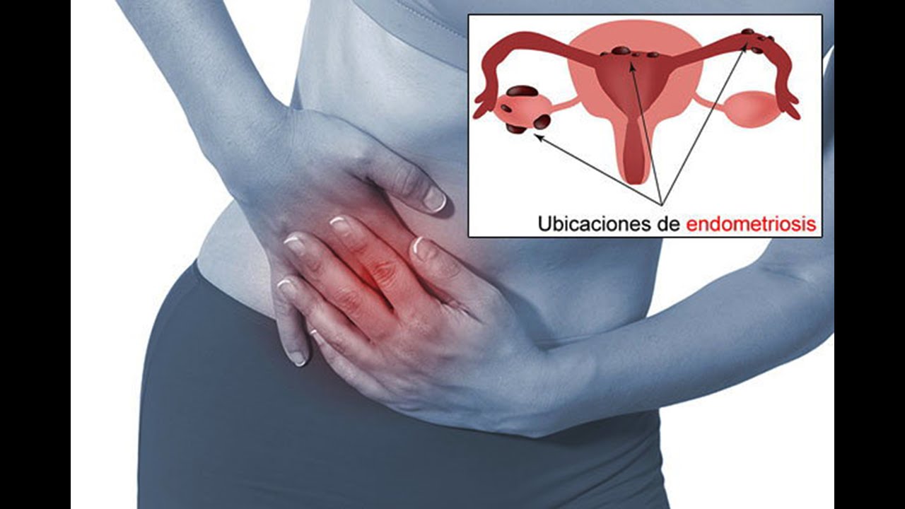 Endometriosis dolor después de la regla