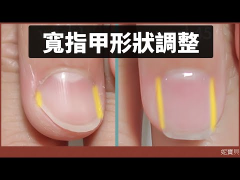 甲型調整｜寬指甲形狀調整｜扇形指甲 甲床萎縮 摳咬指甲 問題指甲矯正計畫