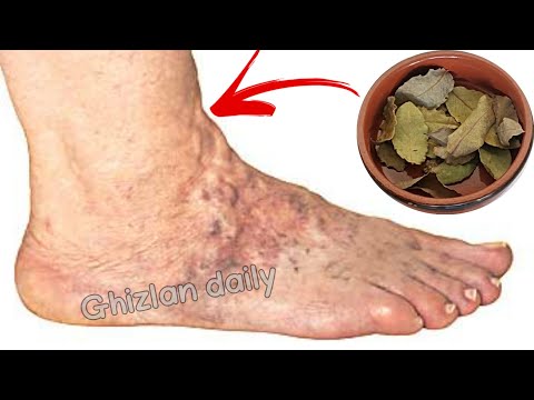 Apply it before bed and it will rid you of varicose veins and spider veins for good in 7 days