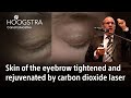 Skin of the eyebrow tightened and rejuvenated by carbon dioxide laser (12 22085)