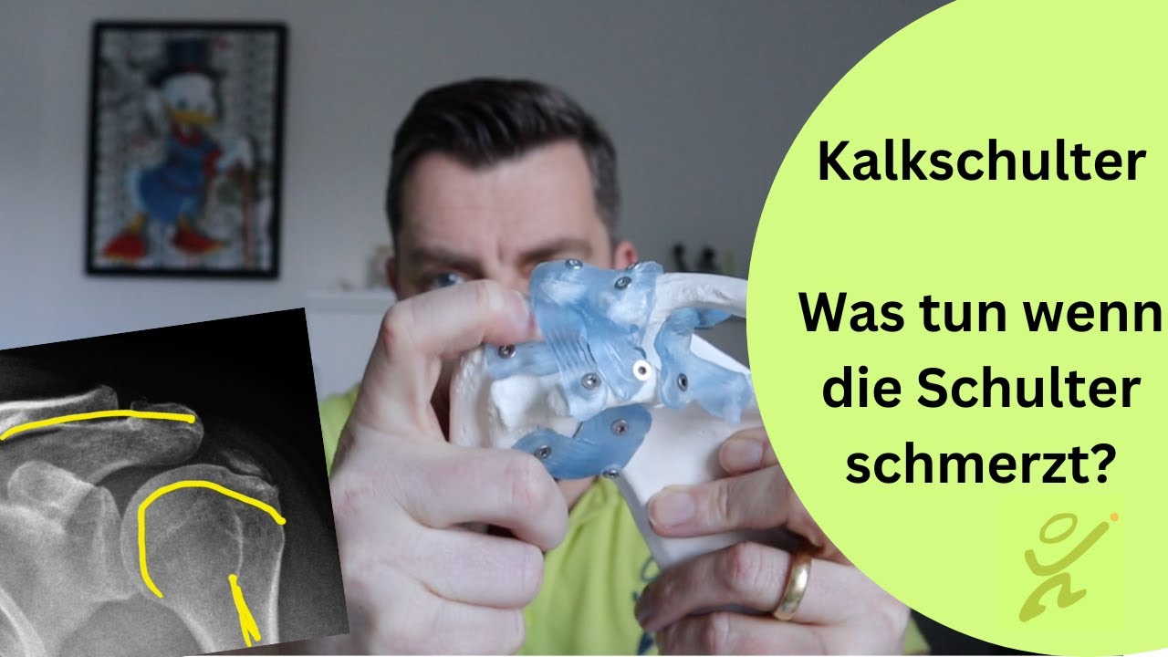 Kalkschulter - Was tun wenn sie Schulter schmerzt? - YouTube