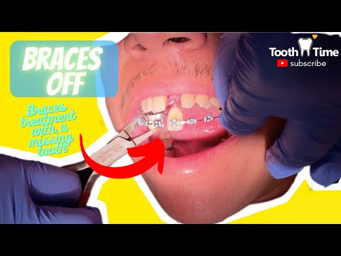 What does a reverse curve wire do for braces? 1 Month Check Up