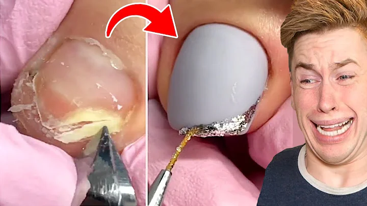 MOST AMAZING TOENAIL TRANSFORMATIONS