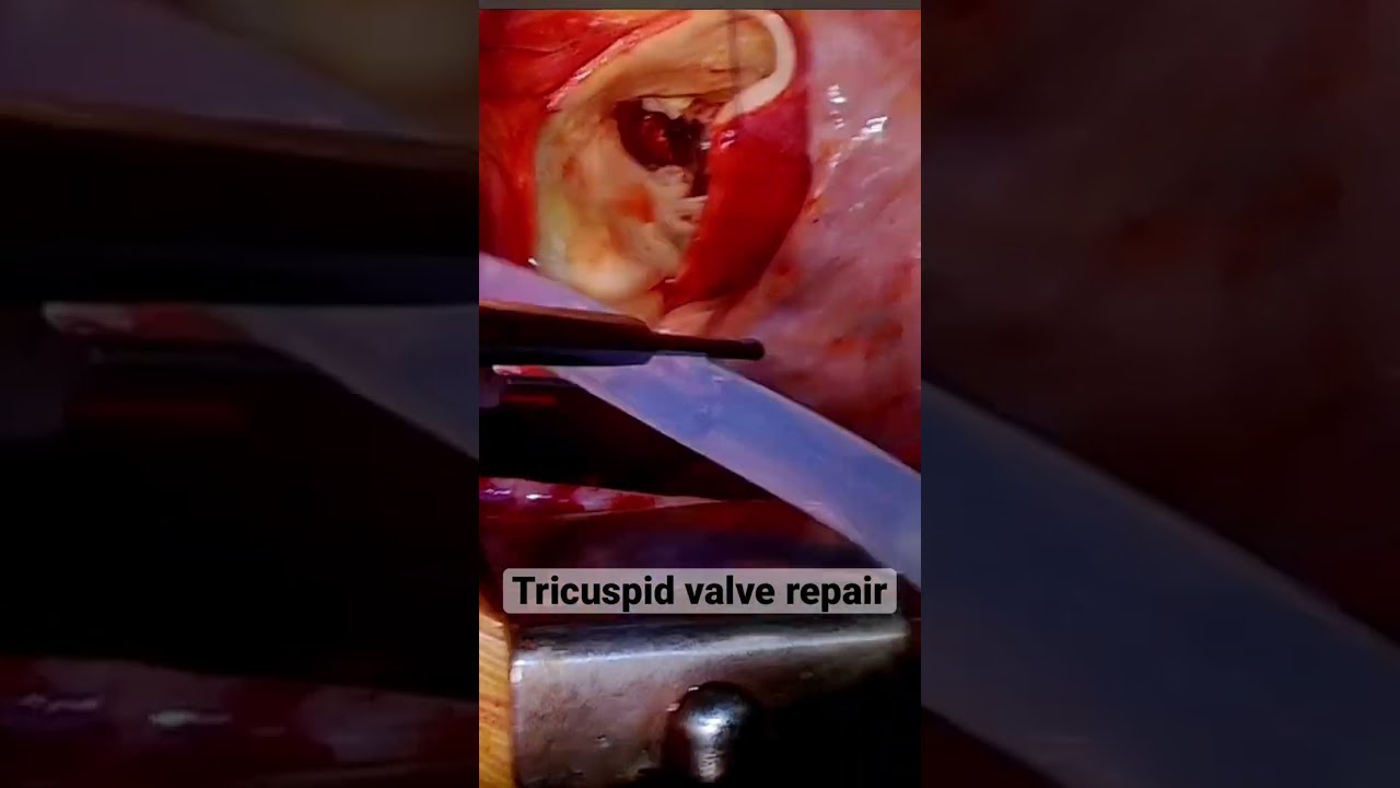 Tricuspid heart valve repair- testing the valve