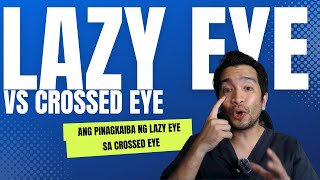 Lazy Eye Vs Crossed Eye Hindi Lahat Ng Duling O Banlag Ay Lazy Eye