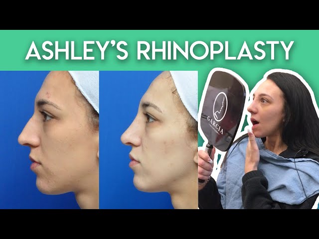 Ashley's Rhinoplasty Journey