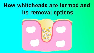 How whiteheads are formed and whiteheads removal options?