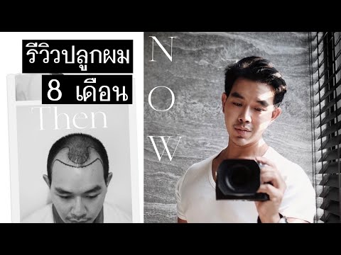 รีวิวปลูกผม " 8 เดือน" ปังมากก !!! FRANKPHAIBUL
