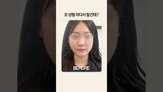 예쁜 코 성형 비법을 공유합니다 #shorts