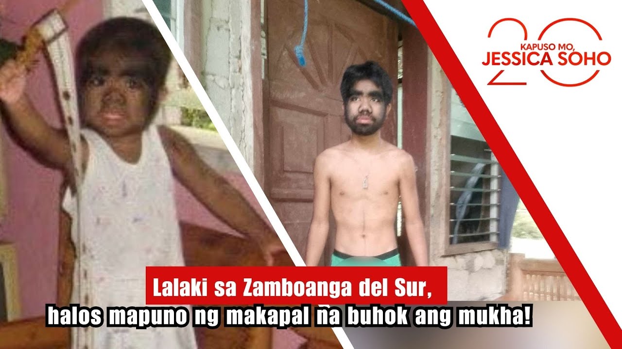 Young man from Zamboanga del Sur has face covered in thick hair! | Kapuso Mo, Jessica Soho
