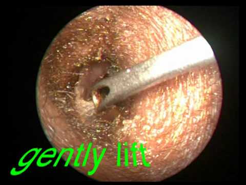 Play Ear Wax Removal Videos 57