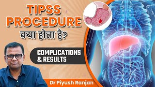 TIPSS Procedure क्या होता है? | TIPS Complications and Results? | Dr. Piyush Ranjan