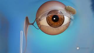 What is endoscopic dacryocystorhinostomy (DCR) surgery for blocked tear ducts? screenshot 2