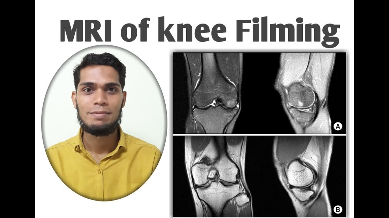 Anterior Cruciate Ligament (ACL) tear - Mediphany