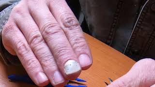 Injured - Ripping Off My Fingernail