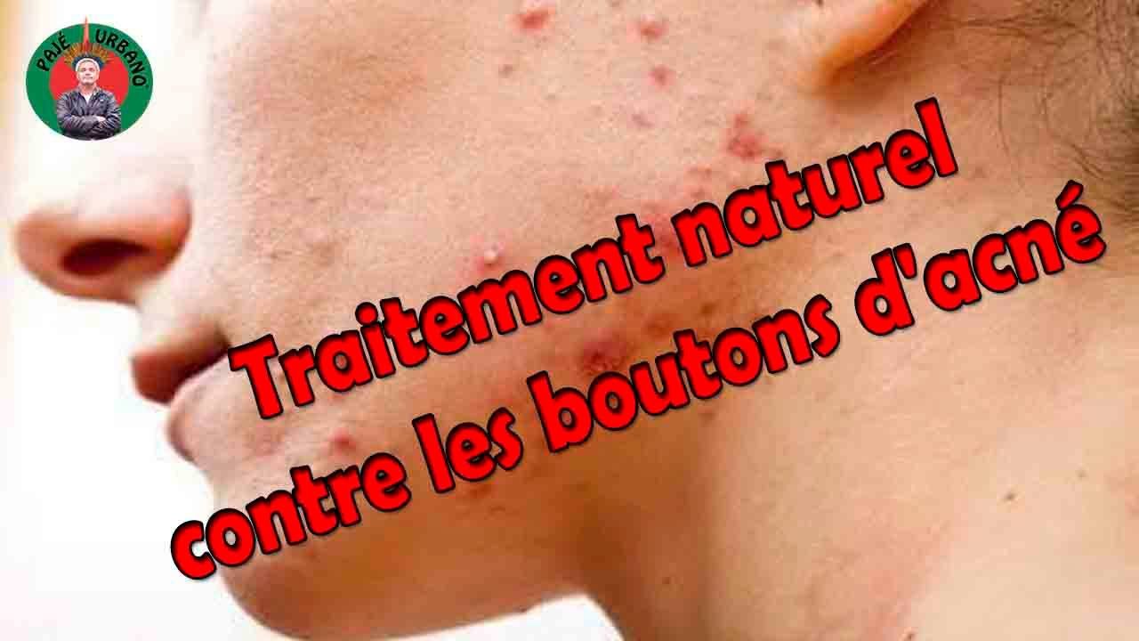 traitement naturel contre les boutons d'acné avec le traitement naturel contre les boutons d'acné avec le