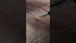 Schonende Entfernung einer Hautveränderung | Plasma Pen #plasmapen #hautstraffung #hautveränderung