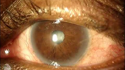 Meibomian Gland Dysfunction